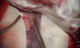 Dissection de la Scissure Sylvienne