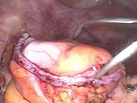 Colectomie totale laparoscopique avec anastomose iléorectale pour inertie colique