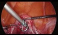 Hystérosacropexie laparoscopique