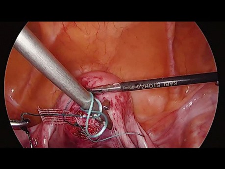 Hystérosacropexie laparoscopique