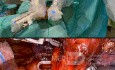 Chirurgie Robotisée du Cancer du Poumon