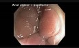 Coloscopie du Canal Anal - Papillome et Cancer