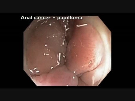 Coloscopie du Canal Anal - Papillome et Cancer