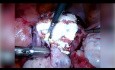TachoSil pour une Meilleure Hémostase et un Meilleur Maintien des Sutures après Enucléation Laparoscopique de Fibrome