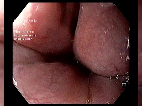 Post EVL – Ligature Élastique – Image de la Guérison Œsophagienne et des Complications