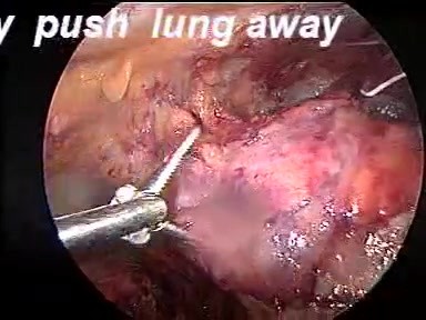 Thymectomie par thoracoscopie vidéo-assistée (TVA) - anatomie
