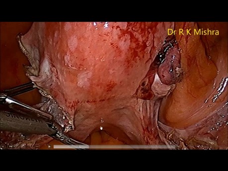 Dr. R.K Mishra Conférence en direct sur l'hystérectomie totale par laparoscopie 