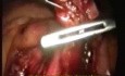 Curage ganglionnaire para-aortique par voie laparoscopique