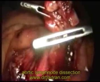 Curage ganglionnaire para-aortique par voie laparoscopique