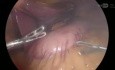 Gastrectomie Sleeve Laparoscopique