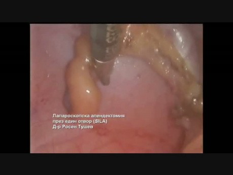 Appendicectomie Laparoscopique à Incision Unique (SILA)
