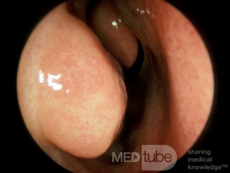 Turbinate inférieur vasoconstricté [gauche]