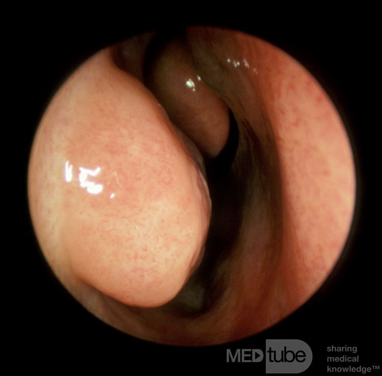 Turbinate inférieur vasoconstricté [gauche]