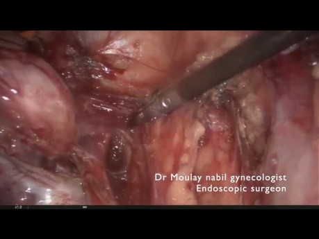 Annexectomie complexe avec urétérolyse