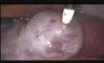 Syndrome d'hyperstimulation ovarienne lors de la fécondation in vitro avec gangrène de l'ovaire droit