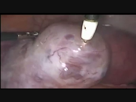 Syndrome d'hyperstimulation ovarienne lors de la fécondation in vitro avec gangrène de l'ovaire droit