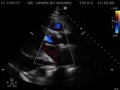 Epanchement péricardique postopératoire -la radiographie du thorax, l'échocardiographie et le traitement