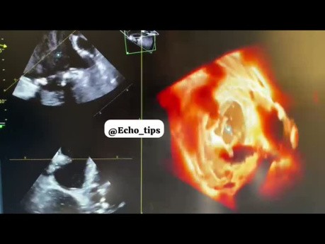 Appendice Auriculaire Gauche - Echocardiographie