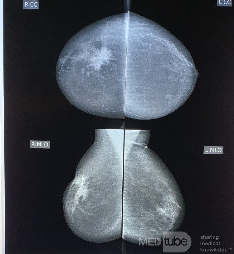 Mammographie