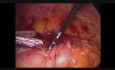 Hémicolectomie droite par voie laparoscopique - approche cranio-caudale