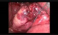 Chirurgie minilaparoscopique  - Le 2e Reduced Port Surgery Forum