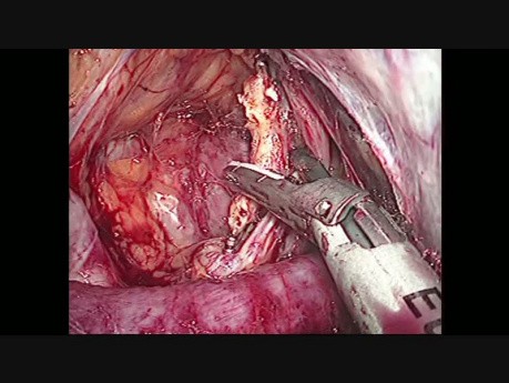 Surrénalectomie droite par laparoscopie