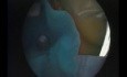 Hypoplasie du sinus maxillaire de type 2 - Drainage endoscopique