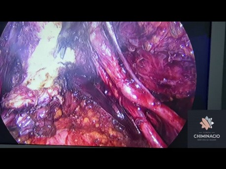 Excision de l'Endométriose Profonde avec Péritonectomie et Résection d'un Nodule Rétrocervical