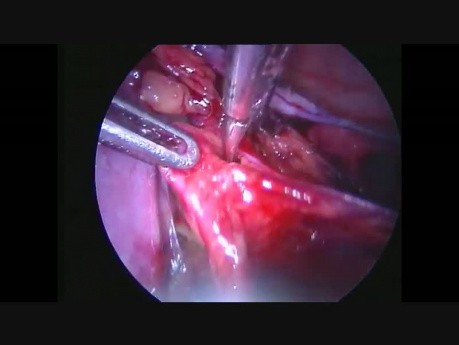 Hysterectomie elargie, curage gonglionn