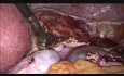 Hystérectomie Laparoscopique Totale pour Fibrome de Taille de 30 Semaines