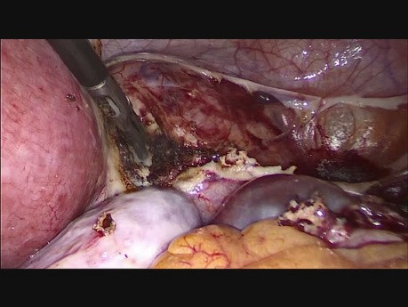 Hystérectomie Laparoscopique Totale pour Fibrome de Taille de 30 Semaines