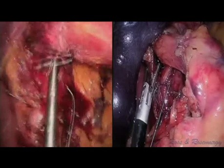 Fundoplicature de Nissen LESS: une Technologie Révolutionnaire pour la Suture