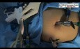 Ablation laparoscopique et fulguration de l'endométriose du cul-de-sac