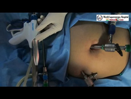 Ablation laparoscopique et fulguration de l'endométriose du cul-de-sac