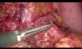 Énucléation de l'insulinome pancréatique par voie laparoscopique
