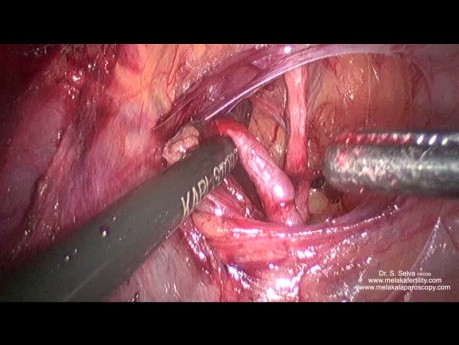 Dissection antérieure et ligature de l'artère utérine à son origine dans un grand utérus 