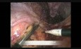 Adrénalectomie droite difficile par laparoscopie