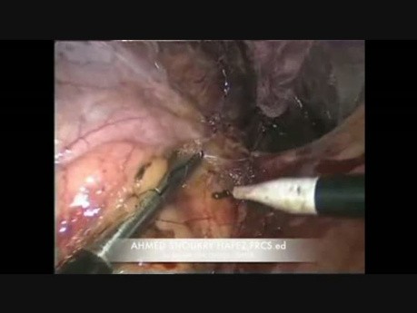 Adrénalectomie droite difficile par laparoscopie