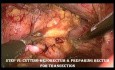Résection Antérieure basse  ( LAR - Low Anterior  Resection ) du rectum par voie laparoscopique