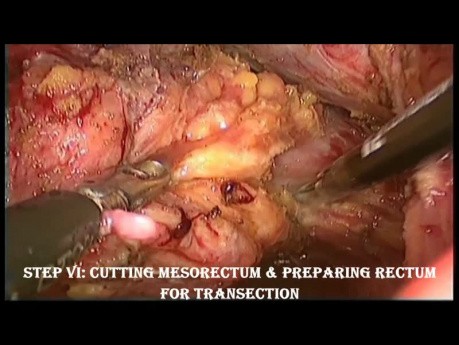 Résection Antérieure basse  ( LAR - Low Anterior  Resection ) du rectum par voie laparoscopique