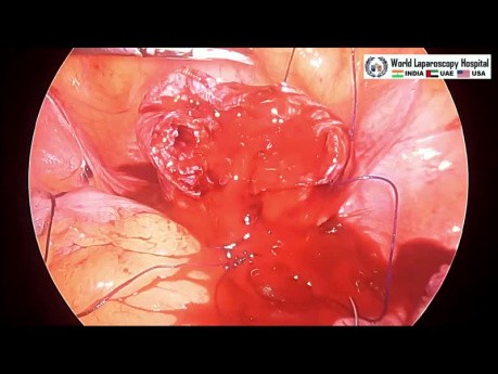Utérus fibrome de la paroi latérale de la myomectomie laparoscopique