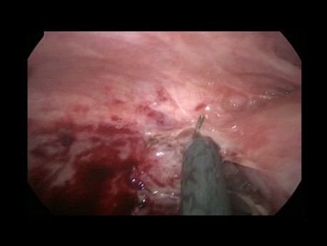 Prise en charge de l'appendicite gangréneuse avec péritonite généralisée et abcès pelvien par voie mini-invasive