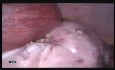 Opération d'un grand kyste ovarien par voie laparoscopique pendant la grossesse (18 SA)