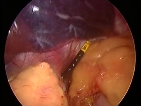 Pose de l'anneau gastrique par laparoscopie