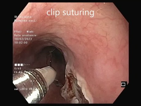 Résection de Tumeur Sous-Muqueuse Oesophagienne