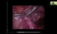 Traite tubaire laparoscopique pour la grossesse ectopique distale