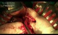 Chirurgie d'un tumeur stromale gastro-intestinale (GIST) de l'estomac