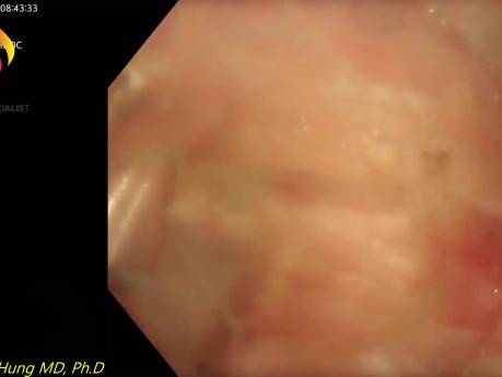 U-STER pour Tumeur Sous-muqueuse Près de l'Angle de His