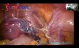 Hystérectomie laparoscopique la plus rapide et la plus sûre