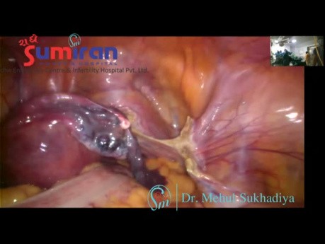 Hystérectomie laparoscopique la plus rapide et la plus sûre